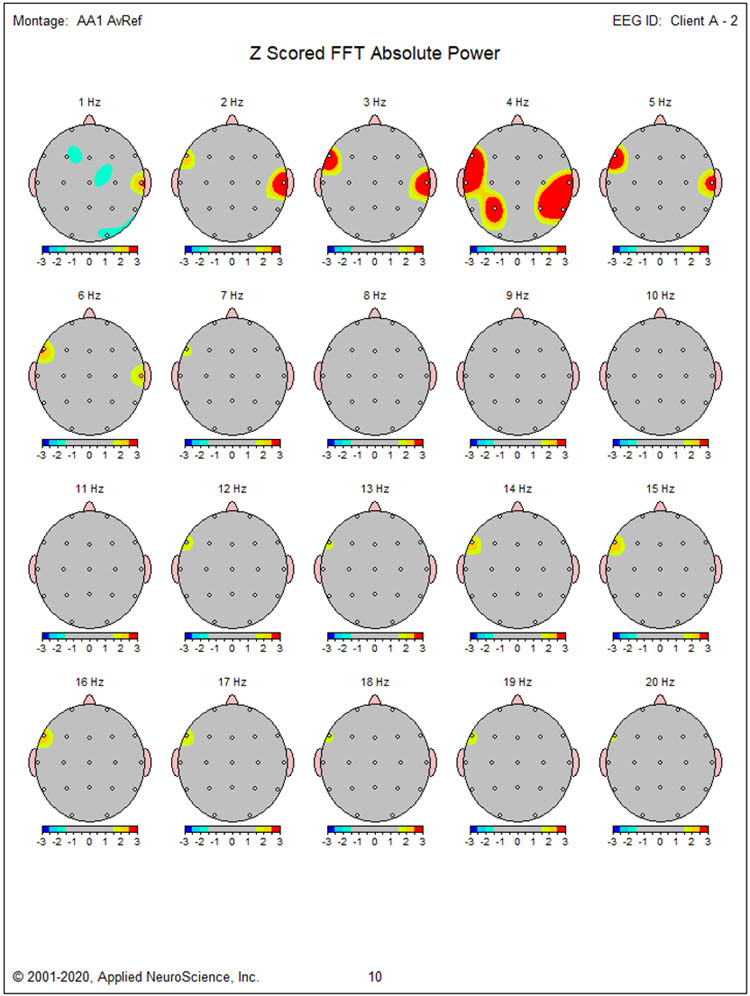 Second recording statistical topographic maps showing reduced excess activity